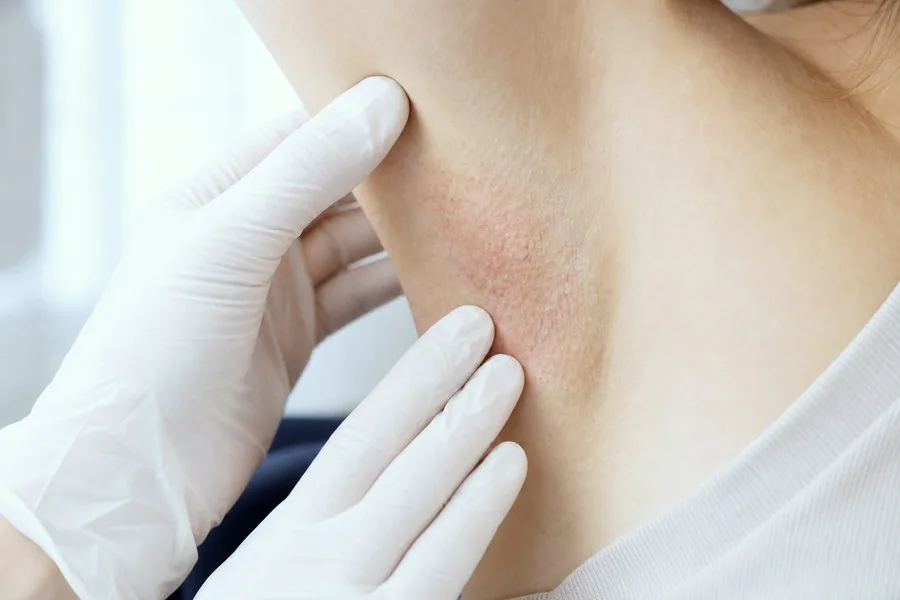 Hidradenitis Suppurativa examination by a consultant