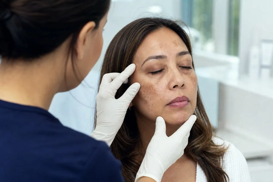 Melasma examination by a consultant