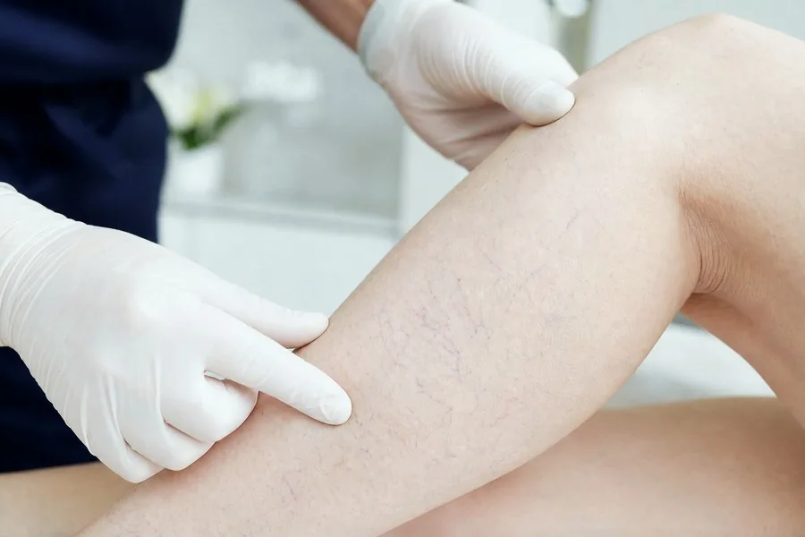 Thread & spider veins examination by a consultant